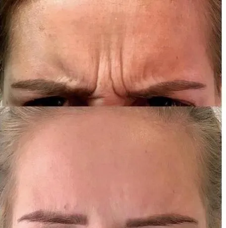 Ботулинотерапия в Челябинске — разглаживание мимических морщин без операции и без «заморозки» лица