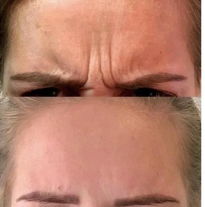 Ботулинотерапия в Челябинске — разглаживание мимических морщин без операции и без «заморозки» лица